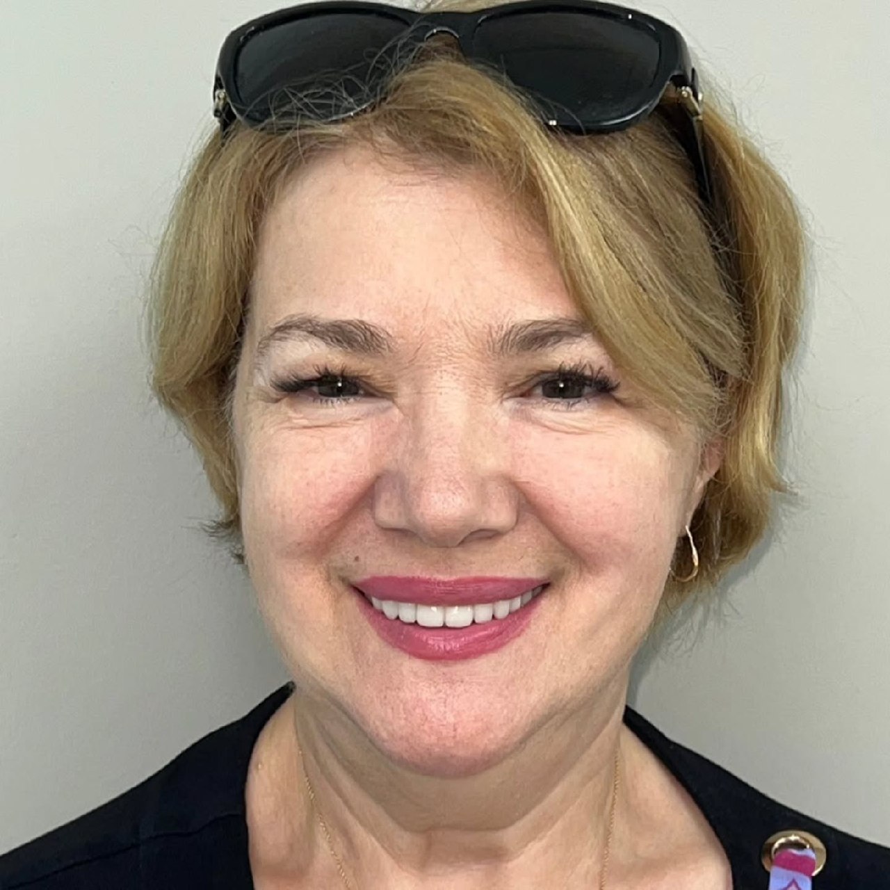 After — restored upper smile