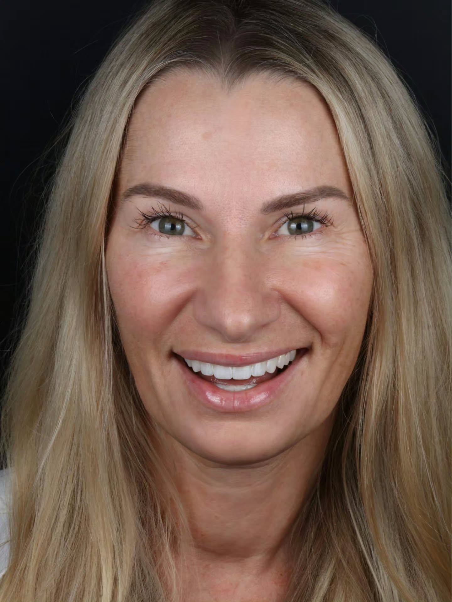 After — six upper front teeth restored with artistic composite