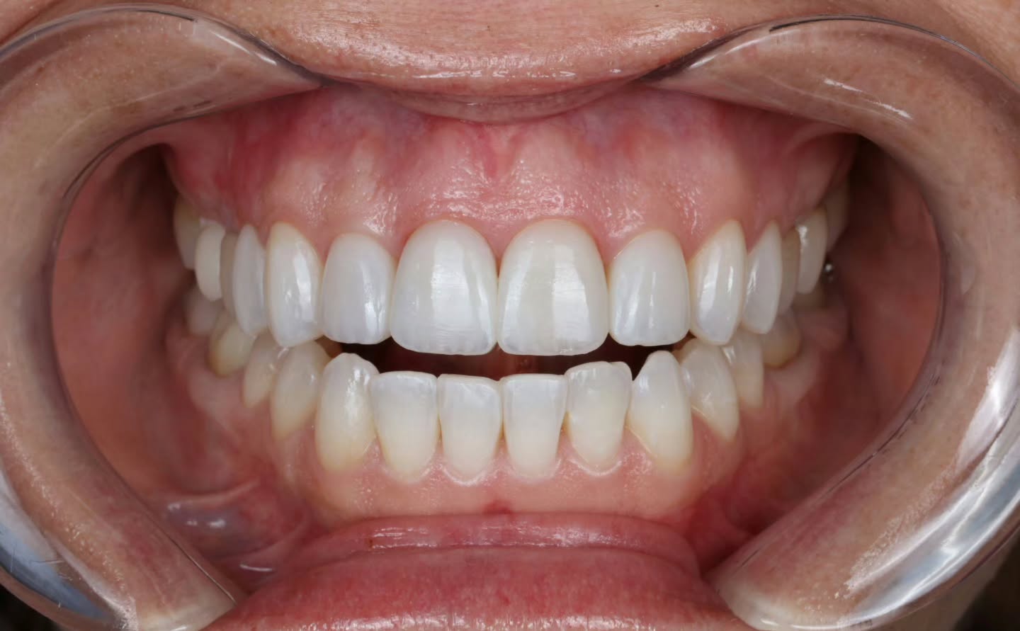 After — eight upper teeth restored additively