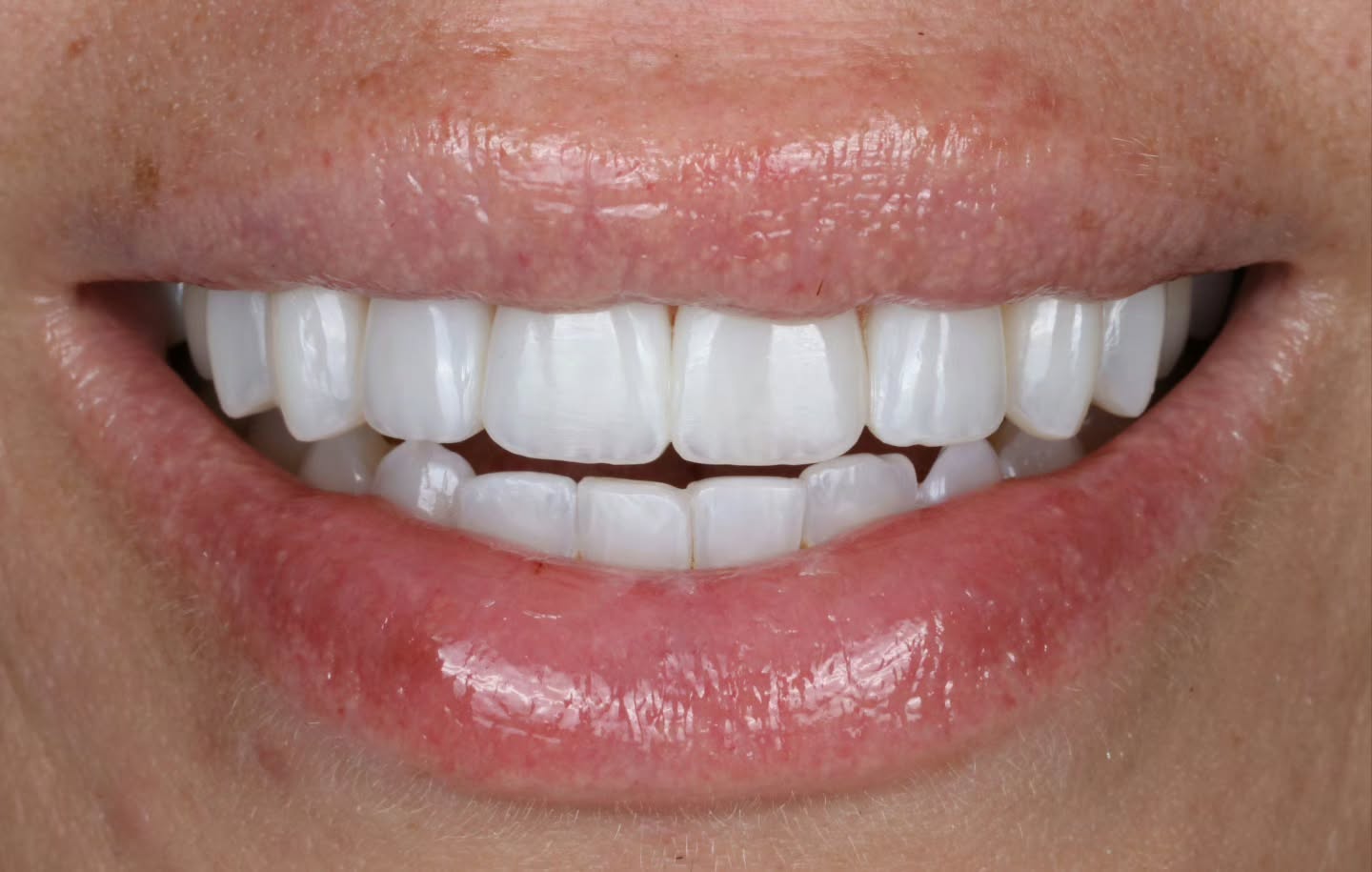 After — gum contouring and composite bonding