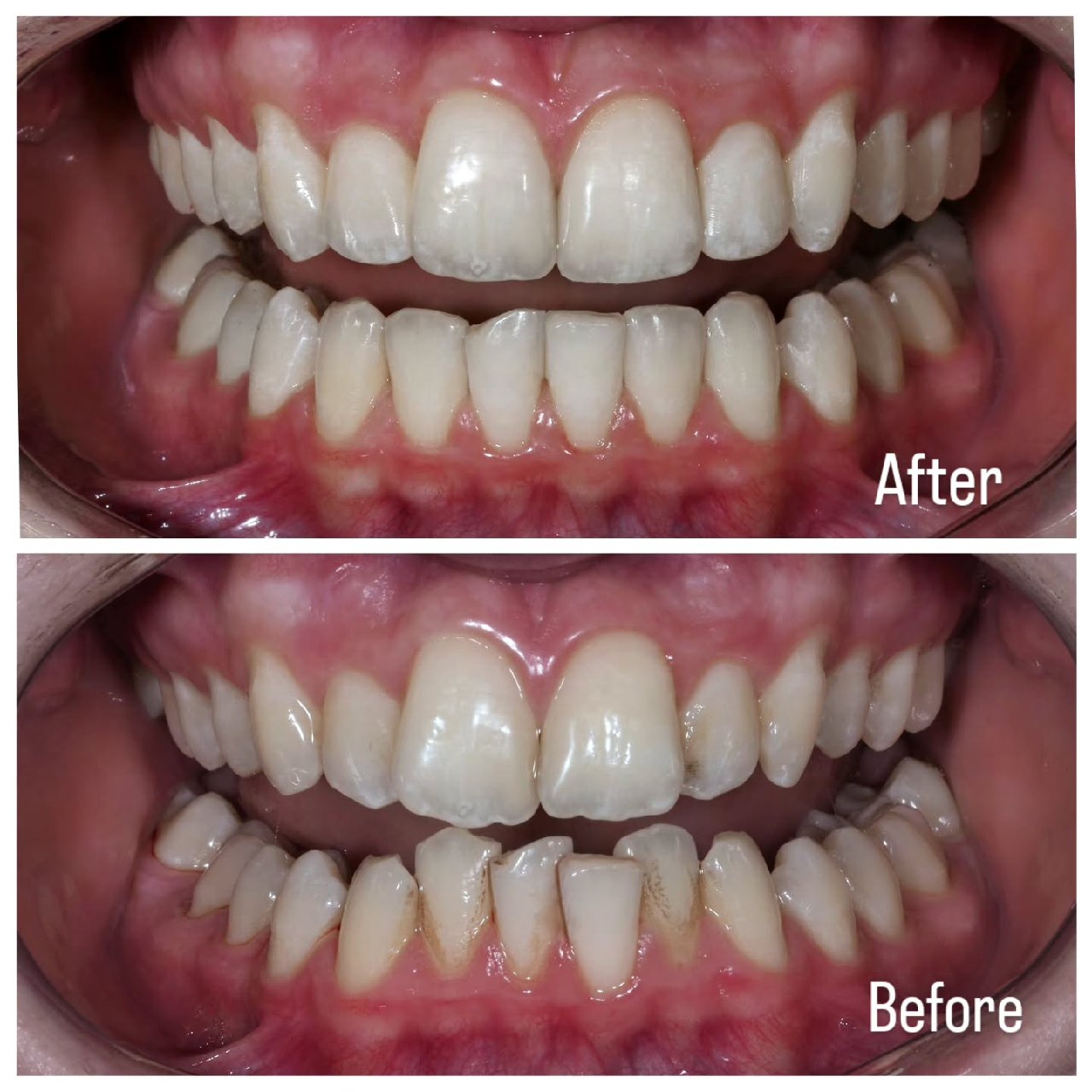 After — Invisalign treatment