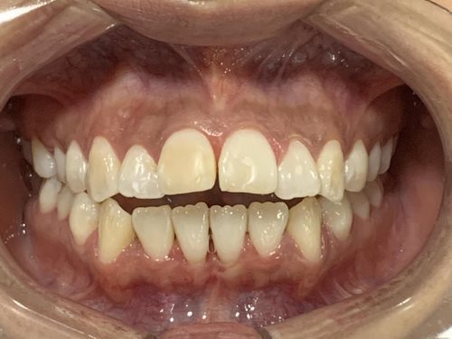 Antes del tratamiento Invisalign