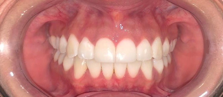 Después del tratamiento Invisalign