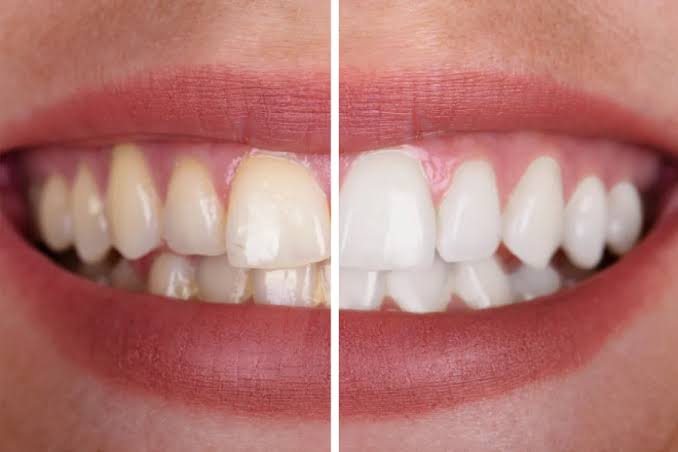 Blanqueamiento dental