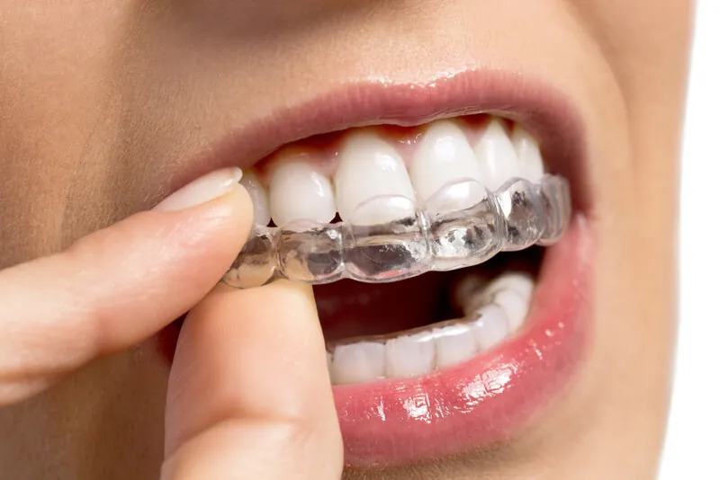 Close-up of a clear aligner being placed over the top teeth