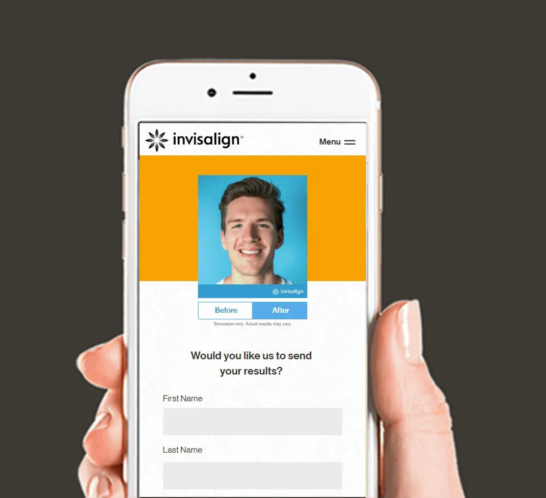 Phone showing an Invisalign smile preview app
