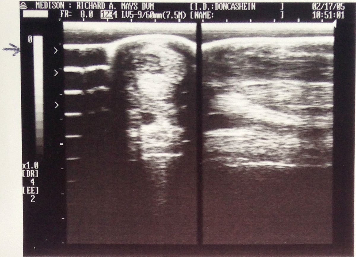 Ultrasound before the Runner's Relief routine